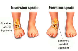 ankle-sprain-ligs